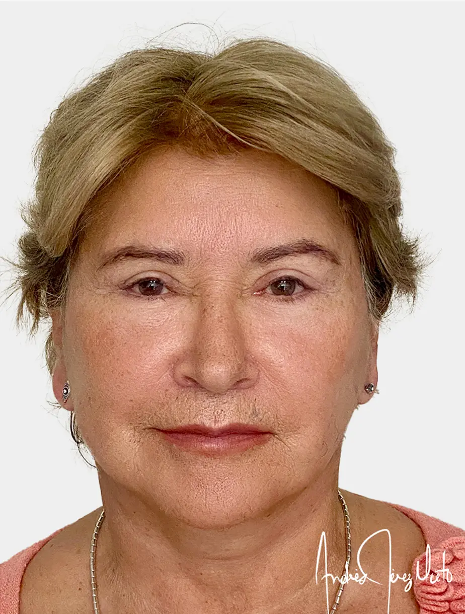 Resultado Lip Lift 4